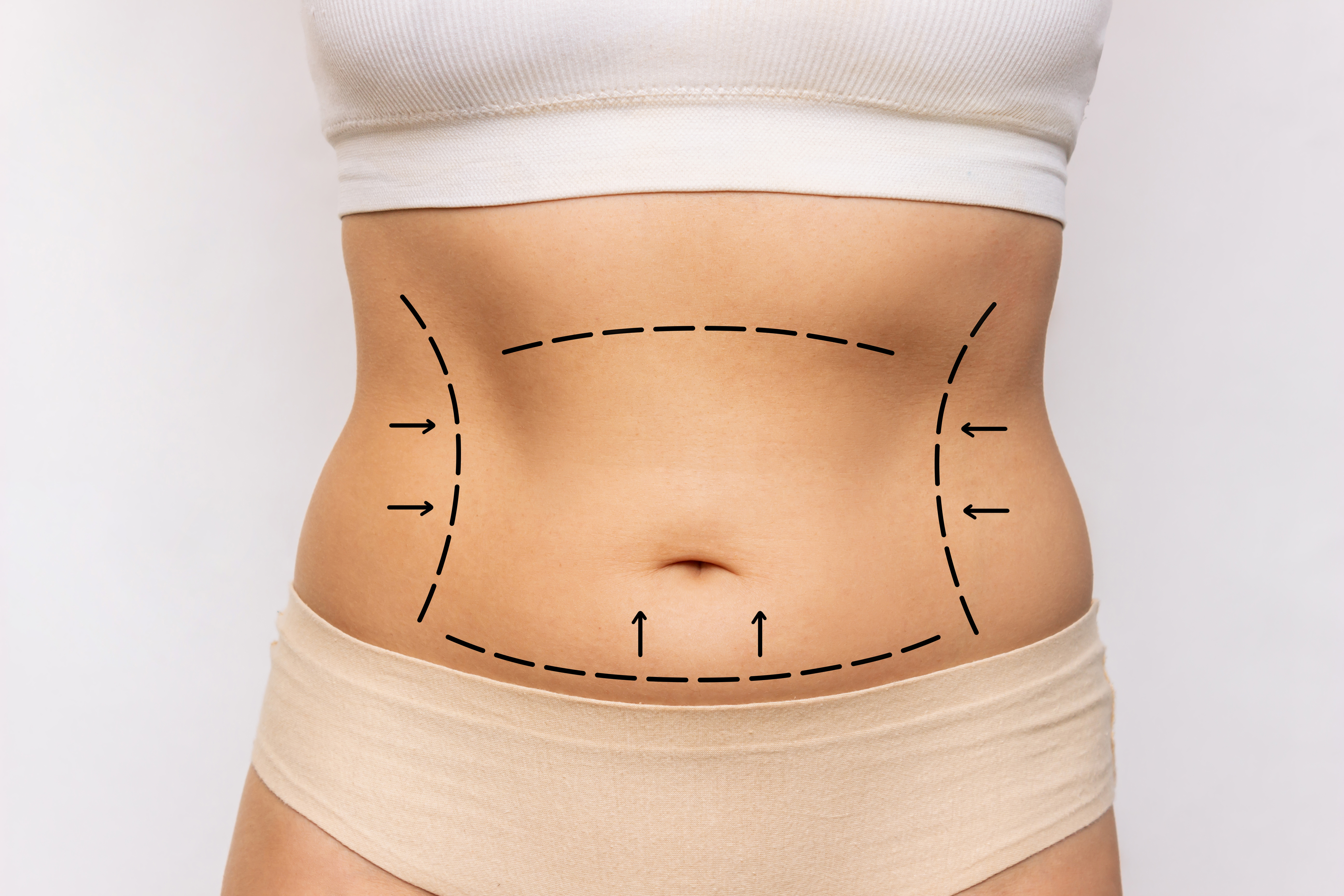 Tummy Tuck