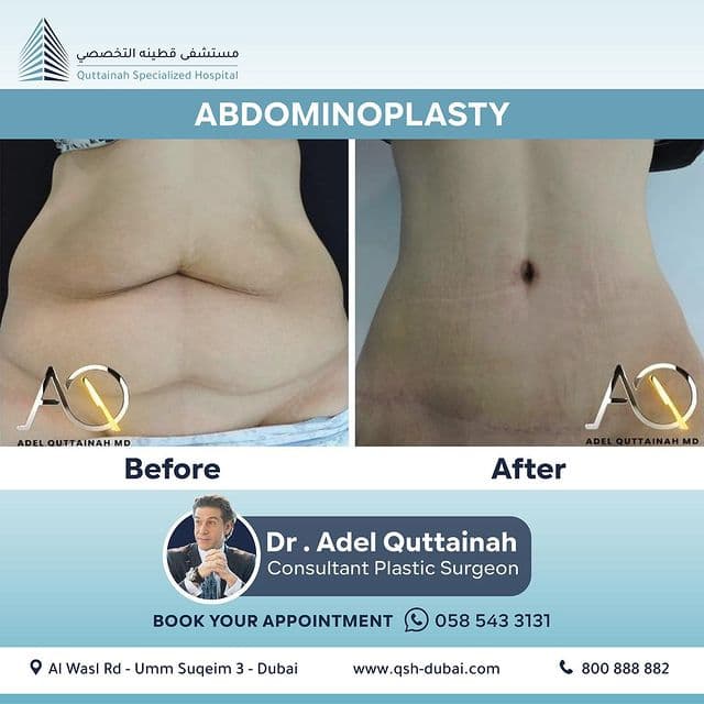 Abdominal Contouring Before and After