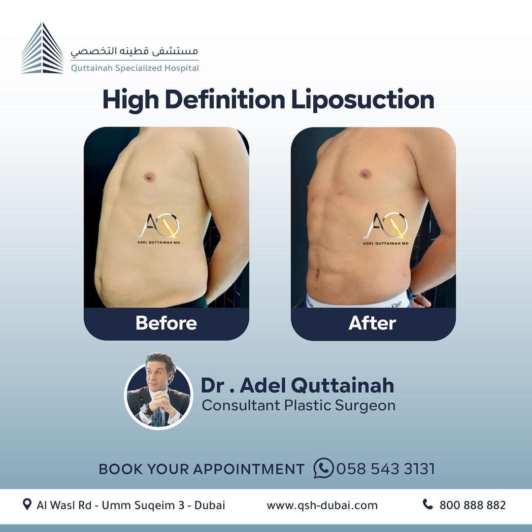 VASER Liposuction Before and After