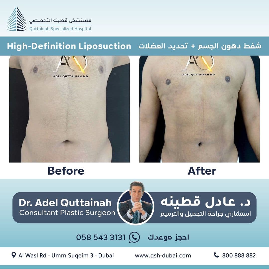 VASER Liposuction Before and After
