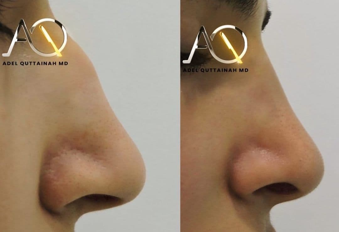 Rhinoplasty Before and After