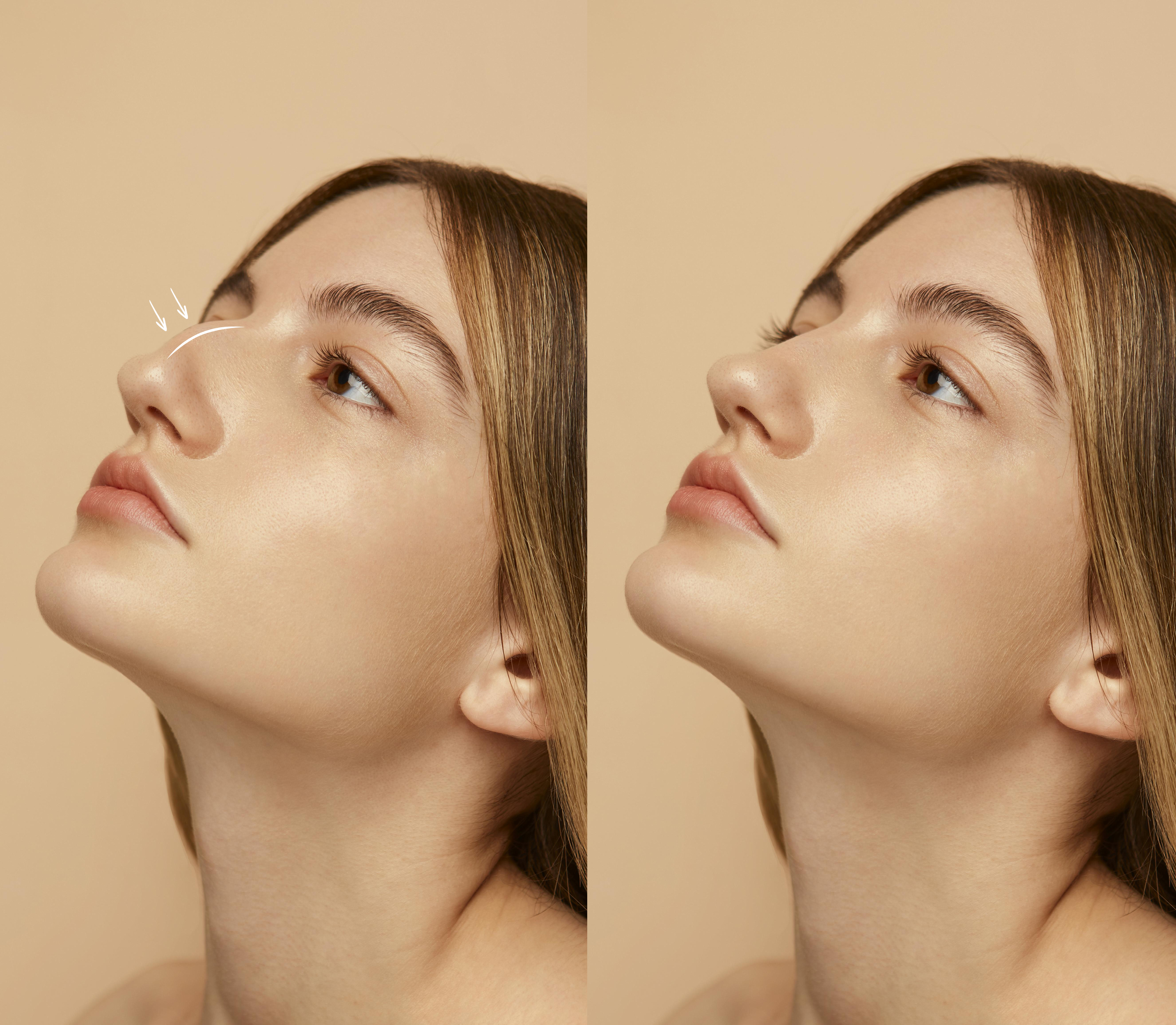Rhinoplasty Background